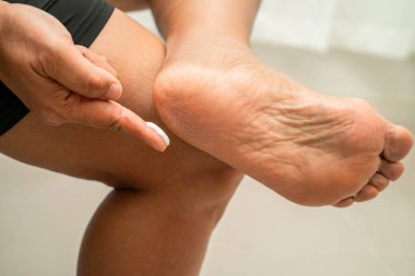 Asyalı bir kadın, çatlak ve kuru topuk derisi ile ayakları çözmek ve onarmak için nemlendirici krem cilt tedavisi uyguluyor..