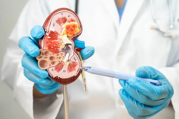 stock image Kidney disease, Chronic kidney disease ckd, Doctor hold human model to treat and study in hospital.