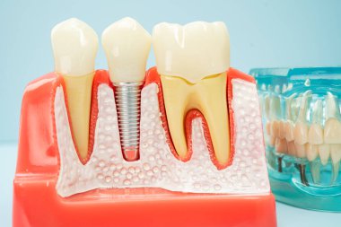 Çene içine yapay diş kökleri diş implantı, diş hekimi için kök kanal modeli.