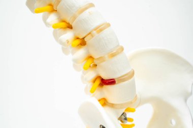 Bel omurgası yerinden oynamış disk parçası, omurilik ve kemik. Ortopedi bölümünde tedavi için model.