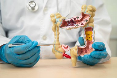 Ülseratif Kolit. Bağırsak, apandis ve sindirim sistemi, hastanede teşhis ve tedavi için anatomi modelini tutan doktor..