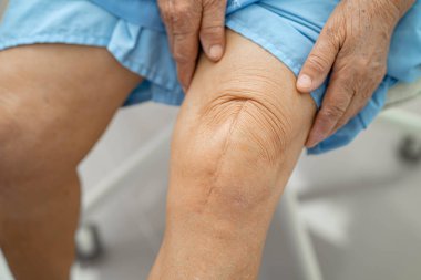 Asyalı yaşlı kadın hasta yaralarını gösteriyor. Diz eklemi ameliyatı. Yara eklemi artroplasti..