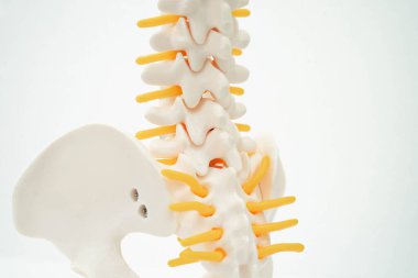 Bel omurgası yerinden oynamış disk parçası, omurilik ve kemik. Ortopedi bölümünde tedavi için model.