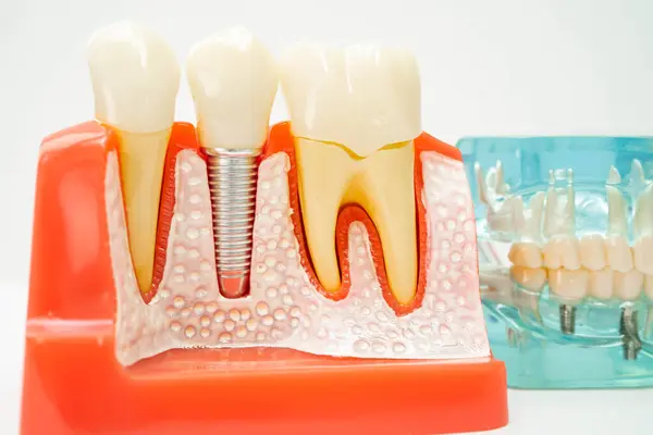 Stock image Artificial tooth roots dental implant into jaw, Root canal model for dentist.