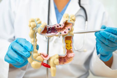 Ülseratif Kolit. Bağırsak, apandis ve sindirim sistemi, hastanede teşhis ve tedavi için anatomi modelini tutan doktor..