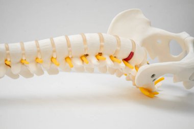 Bel omurgası yerinden oynamış disk parçası, omurilik ve kemik. Ortopedi bölümünde tedavi için model.
