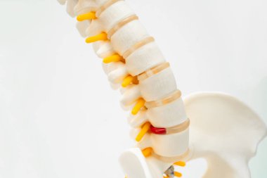 Bel omurgası yerinden oynamış disk parçası, omurilik ve kemik. Ortopedi bölümünde tedavi için model.