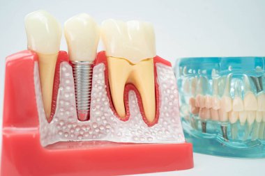Çene içine yapay diş kökleri diş implantı, diş hekimi için kök kanal modeli.