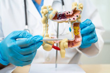 Ülseratif Kolit. Bağırsak, apandis ve sindirim sistemi, hastanede teşhis ve tedavi için anatomi modelini tutan doktor..