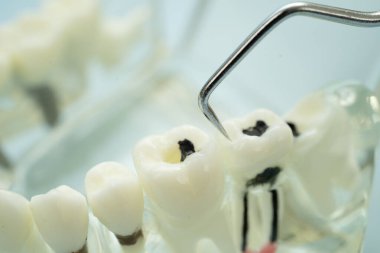 Diş sağlığı tedavisinde kullanılan dişçi aracına sahip diş modeli. 