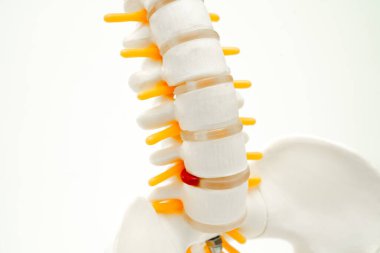 Omurga ve kemik, bel kemiği yerinden oynamış disk parçası, ortopedi bölümünde tedavi için model..