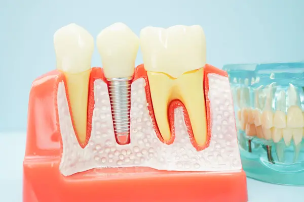 stock image Dental implant, artificial tooth roots into jaw, root canal of dental treatment, gum disease, teeth model for dentist studying about dentistry.