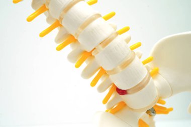 Omurga ve kemik, bel kemiği yerinden oynamış disk parçası, ortopedi bölümünde tedavi için model..