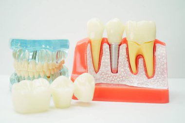 Diş implantı, çeneye yapay diş kökleri, diş tedavisinin kök kanalı, diş eti hastalığı, diş hekimliği üzerine çalışan dişçi modeli.