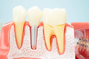 Diş implantı, çeneye yapay diş kökleri, diş tedavisinin kök kanalı, diş eti hastalığı, diş hekimliği üzerine çalışan dişçi modeli.