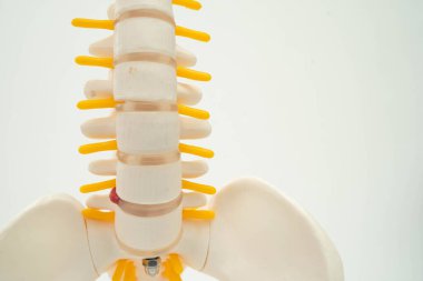 Omurga ve kemik, bel kemiği yerinden oynamış disk parçası, ortopedi bölümünde tedavi için model..