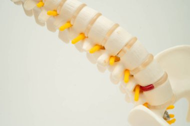 Omurga ve kemik, bel kemiği yerinden oynamış disk parçası, ortopedi bölümünde tedavi için model..