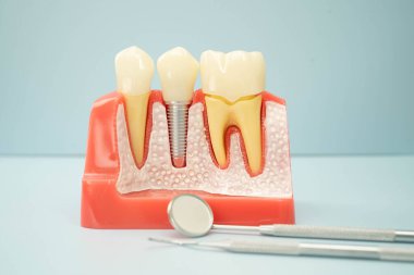 Diş implantı, çeneye yapay diş kökleri, diş tedavisinin kök kanalı, diş eti hastalığı, diş hekimliği üzerine çalışan dişçi modeli.