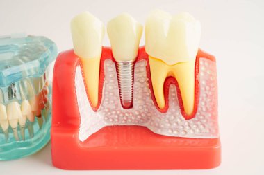 Diş implantı, çeneye yapay diş kökleri, diş tedavisinin kök kanalı, diş eti hastalığı, diş hekimliği üzerine çalışan dişçi modeli.