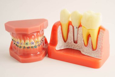 Diş implantı, çeneye yapay diş kökleri, diş tedavisinin kök kanalı, diş eti hastalığı, diş hekimliği üzerine çalışan dişçi modeli.
