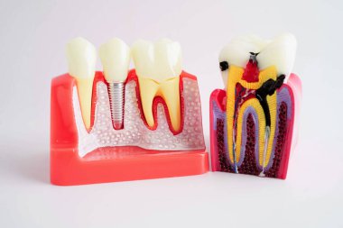 Diş implantı, çeneye yapay diş kökleri, diş tedavisinin kök kanalı, diş eti hastalığı, diş hekimliği üzerine çalışan dişçi modeli.