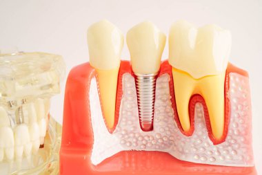 Diş implantı, çeneye yapay diş kökleri, diş tedavisinin kök kanalı, diş eti hastalığı, diş hekimliği üzerine çalışan dişçi modeli.