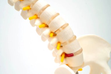 Omurga ve kemik, bel kemiği yerinden oynamış disk parçası, ortopedi bölümünde tedavi için model..