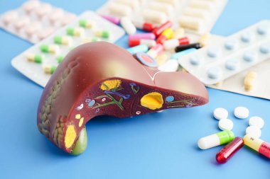 Hap tedavisi gören karaciğer modeli, siroz, karaciğer kanseri, yağlı karaciğer..