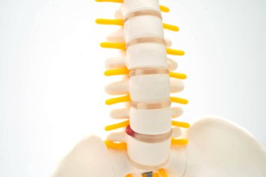 Omurga ve kemik, bel kemiği yerinden oynamış disk parçası, ortopedi bölümünde tedavi için model..