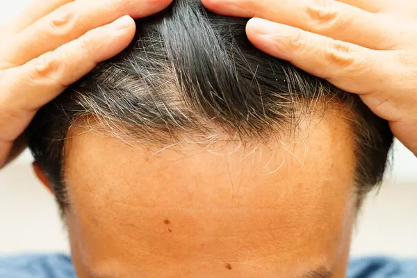 Kel kafalı adam, saç dökülmesi tedavisi sorunu.