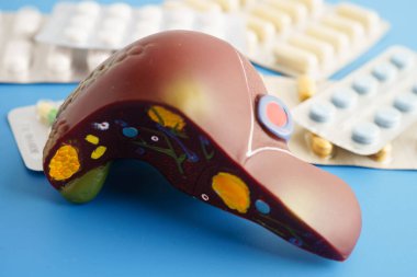 Hap tedavisi gören karaciğer modeli, siroz, karaciğer kanseri, yağlı karaciğer..