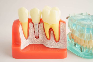 Diş hekimliği hakkında bilgi almak için beyaz arkaplanda diş modeli.