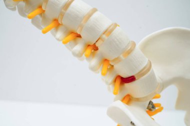 Omurga ve kemik, bel kemiği yerinden oynamış disk parçası, ortopedi bölümünde tedavi için model..