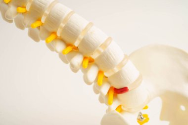 Omurga ve kemik, bel kemiği yerinden oynamış disk parçası, ortopedi bölümünde tedavi için model..