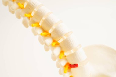 Omurga ve kemik, bel kemiği yerinden oynamış disk parçası, ortopedi bölümünde tedavi için model..