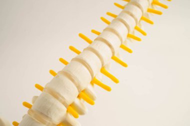 Omurga ve kemik, bel kemiği yerinden oynamış disk parçası, ortopedi bölümünde tedavi için model..