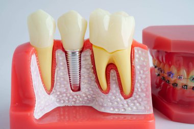 Diş implantı, çeneye yapay diş kökleri, diş tedavisinin kök kanalı, diş eti hastalığı, diş hekimliği üzerine çalışan dişçi modeli.