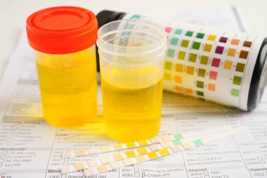 İdrar tahlili, laboratuarda sağlık kontrolü için idrar kabı..