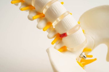 Omurga ve kemik, bel kemiği yerinden oynamış disk parçası, ortopedi bölümünde tedavi için model..