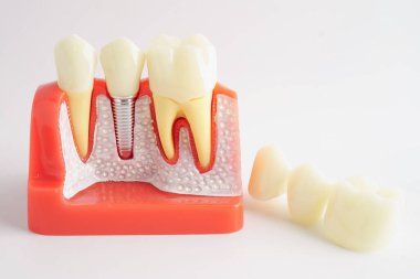 Diş implantı, çeneye yapay diş kökleri.