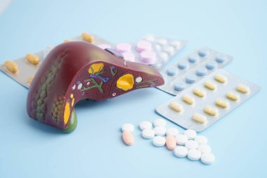 Hap tedavisi gören karaciğer modeli, siroz, karaciğer kanseri, yağlı karaciğer..