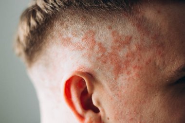 Deride sedef hastalığı, kafa derisi, deri iltihabı ve egzama fotoğrafları, deri sorunları, dermatoloji afişi.