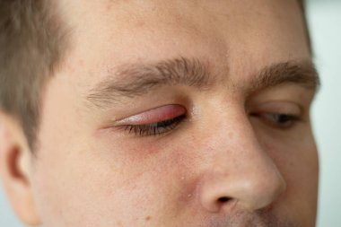 Tıkanmış yağ bezi ve stafilokok bakterileri nedeniyle stye enfeksiyonu başlangıcı ile şişmiş ve ağrılı kırmızı üst göz kapağı seçici odak. Sağ üst göz kapağı apsesi kapatın.