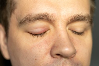 Tıkanmış yağ bezi ve stafilokok bakterileri nedeniyle stye enfeksiyonu başlangıcı ile şişmiş ve ağrılı kırmızı üst göz kapağı seçici odak. Sağ üst göz kapağı apsesi kapatın.