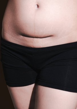 Göbek bölgesinde sezaryen izi var.