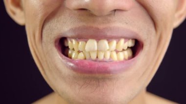 Bir adam sarı dişlerini gösteriyordu.