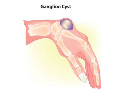 Ganglion Kisti - çoğu zaman el ve el eklemlerinde ya da tendonların etrafında oluşan yumrular