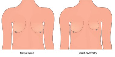Göğüs asimetrisi simetriye karşı