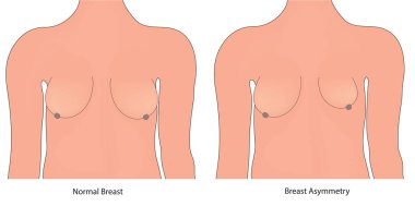 Breast asymmetry vs symmetry clipart