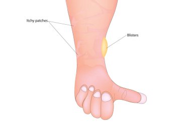 Elinde boğa pemphigoid var.